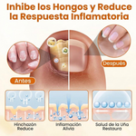 🐝FUNGI BEE - SPRAY - RESTAURADOR DE UÑAS ANTI-HONGOS CON VENENO DE ABEJA🐝